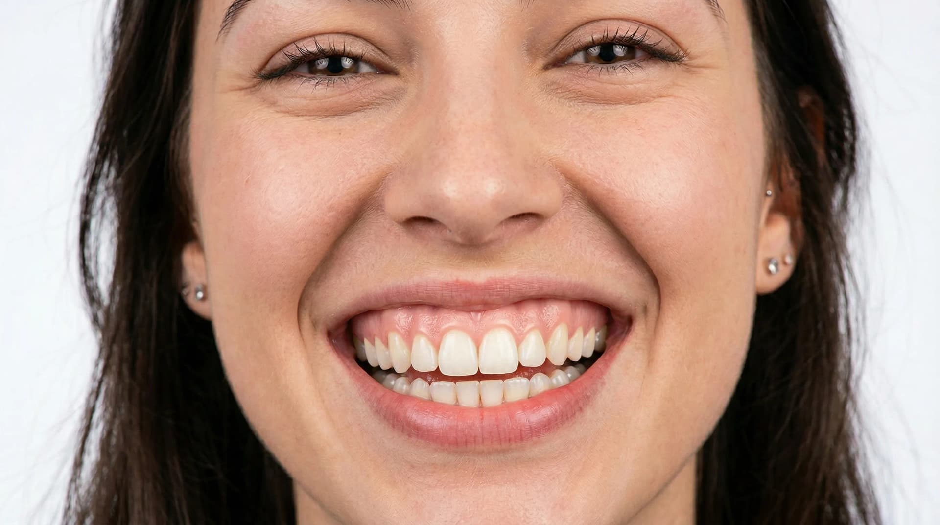Close-up showing white spots on tooth enamel