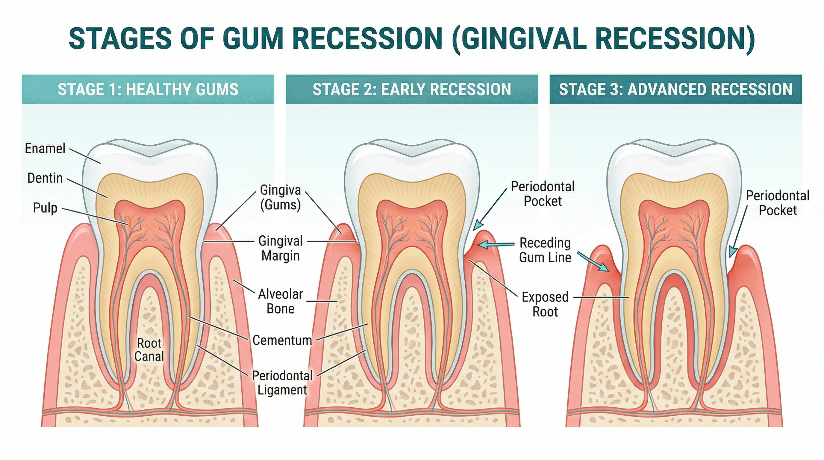 Diagram showing the five progressive stages of tooth decay